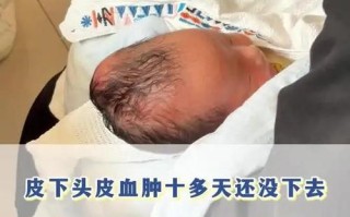 新生儿头皮血肿没满月