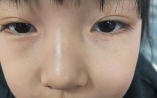 新生儿脸上出血点图片正常吗？需要担心还是会自行消退？