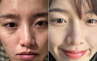 孕期皮肤差生完宝宝后，皮肤状态会自然恢复吗？需要做些什么来帮助改善呢？