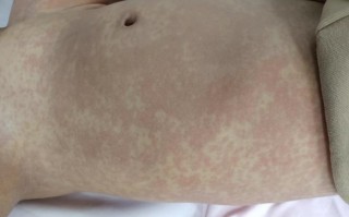 儿童EB病毒感染有哪些典型症状？家长该如何早期识别与应对？