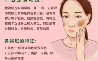 孕期如何有效预防脸上长斑？有哪些科学方法能避免孕期色斑形成？