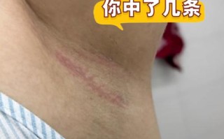 孕期腋窝瘙痒难耐？是激素变化还是皮肤问题在作祟？