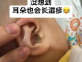 新生儿一只耳朵流黄水
