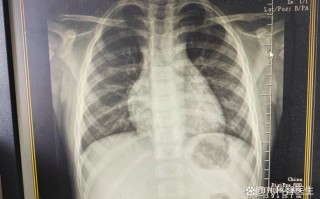 儿童支原体感染有哪些检查方法？不同检查方式适用哪些情况？