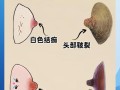 怀孕期间乳晕局部增厚