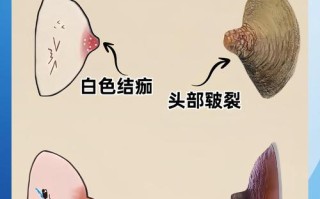 怀孕期间乳晕局部增厚