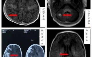 新生儿颅内蛛网膜出血的成因、危害及早期干预措施有哪些？