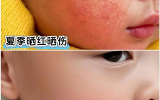 新生儿被太阳晒伤图片警示，家长该如何科学防晒避免悲剧？