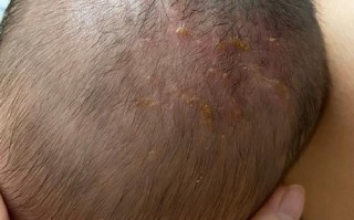 新生儿头发里出现脓包是正常现象吗？需要怎么处理？