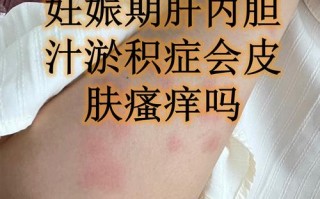 孕期胆汁淤积症有哪些典型症状？对母婴健康有何影响？