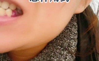 孕期牙龈发炎能自愈吗？不治疗会影响胎儿健康吗？