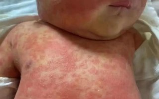 新生儿脸上身上出现小红点是什么原因？需要担心吗？