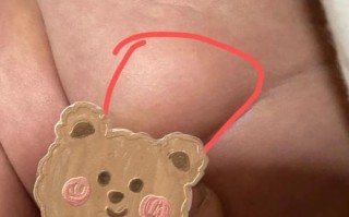 新生儿屁眼有个肉疙瘩是什么？需要担心吗？该怎么处理？