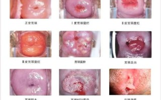 孕期宫颈糜烂会有哪些症状表现？会对胎儿造成影响吗？