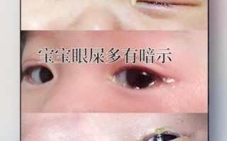 新生儿眼睛黄水流出是正常现象还是异常信号？需警惕哪些眼部疾病风险？