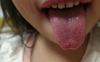 新生儿舌头上的小白点是什么？需要处理吗？对吃奶有影响吗？