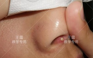 儿童鼻子内长肉疙瘩是什么原因？需要治疗吗？会影响呼吸吗？