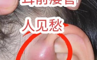 新生儿耳前瘘管不处理会引发哪些严重危害？