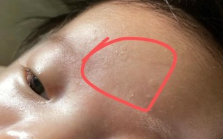 儿童额头长小疙瘩是什么原因？需要警惕哪些疾病？