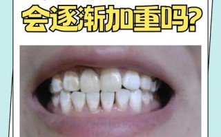 儿童氟斑牙前期图片有哪些典型表现？如何通过早期图片识别与预防？