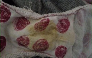 备孕期白带腥味豆腐渣是妇科炎症信号吗？会影响怀孕吗？