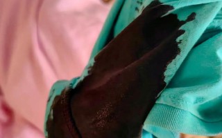 孕期鼻子里经常有血块，是孕期正常现象还是身体发出的健康警报？