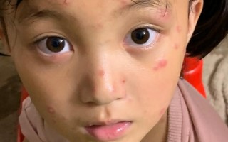 儿童水痘第几天最严重？症状高峰期如何护理？