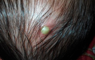 新生儿头顶白色脓包是痱子还是湿疹？需要立即处理吗？