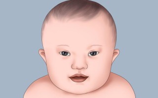 新生儿唐氏综合症症状有哪些？家长该如何早期识别与应对？