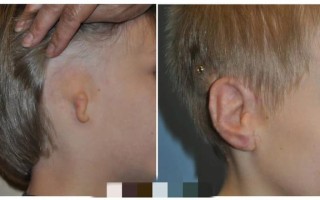 新生儿两个耳朵不对称是发育异常还是正常现象？需要干预吗？