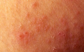 孕期阴部长湿疹，该如何安全治疗与日常护理？