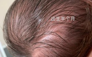 新生儿产瘤与头皮血肿如何区分？对宝宝健康有何影响？