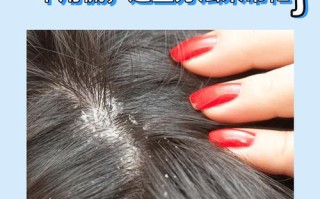 孕期头皮屑严重怎么办