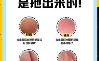 新生儿尿不湿过敏症状有哪些？如何区分与处理？