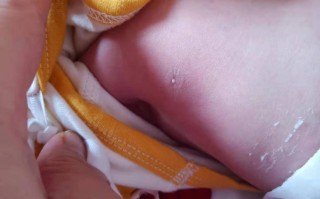 新生儿乳头上出现白点是什么原因？需要处理吗？