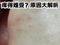 怀孕期间脚丫痒得难受，到底是什么原因引起的？