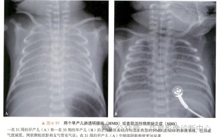新生儿透明膜病为何多见于早产儿及剖宫产儿？