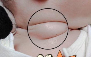 新生儿锁骨处骨头突出是正常生理现象还是骨骼发育异常？