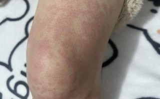 孕期感染torch会对胎儿造成哪些影响？需要做哪些检查来应对？