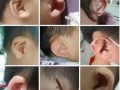 新生儿两只耳朵大小不一，是正常生理差异还是需要干预的异常情况？