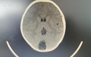 儿童蛛网膜囊肿到底危险吗？需要治疗吗？会影响发育吗？