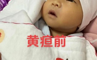 新生儿20多天黄疸还没退，是病理性黄疸还是喂养方式有问题？
