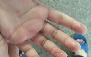 儿童手指上长透明水泡是手足口病还是湿疹？需要警惕哪些问题？