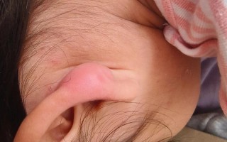 儿童耳朵红肿是过敏还是感染？家长该如何正确处理和护理？