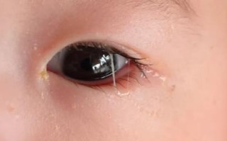 新生儿眼屎多、流泪不止，是上火还是眼睛出问题了？