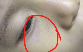 新生儿眼睛里有红点是什么原因？需要担心吗？