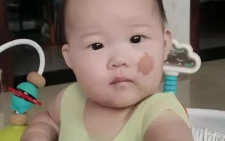 新生儿脸上的胎记需要处理吗？会不会自行消失？如何判断是否需要就医？