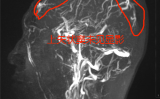 新生儿脑部静脉窦血栓，病因、症状与治疗全解析？
