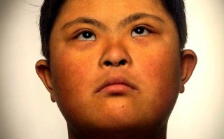 唐氏综合征新生儿有哪些典型表现？如何早期识别与干预？