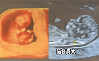孕妇怀孕期间婴儿头大会对分娩和宝宝健康产生哪些影响？